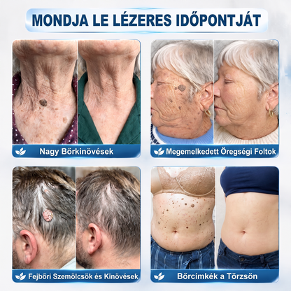 Hivatalos Márkabolt | Hiskin® 7 napos Szemölcseltávolító Roll-on Ápoló Folyadék (Fájdalommentes rollerball technológia, hegek nélkül) 🐬