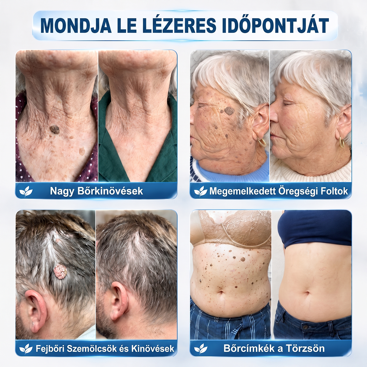 💙Hivatalos Márkabolt | 🚢 Hiskin® 7 napos Szemölcseltávolító Roll-on Ápoló Folyadék (Fájdalommentes rollerball technológia, hegek nélkül) 🐬