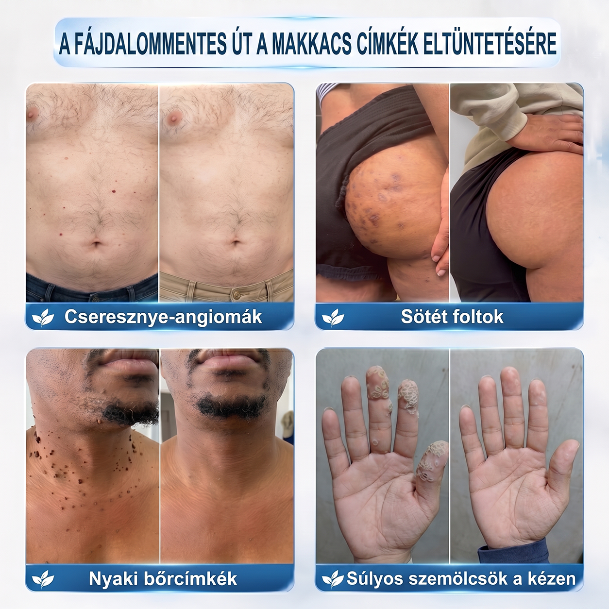 💙Hivatalos Márkabolt | 🚢 Hiskin® 7 napos Szemölcseltávolító Roll-on Ápoló Folyadék (Fájdalommentes rollerball technológia, hegek nélkül) 🐬