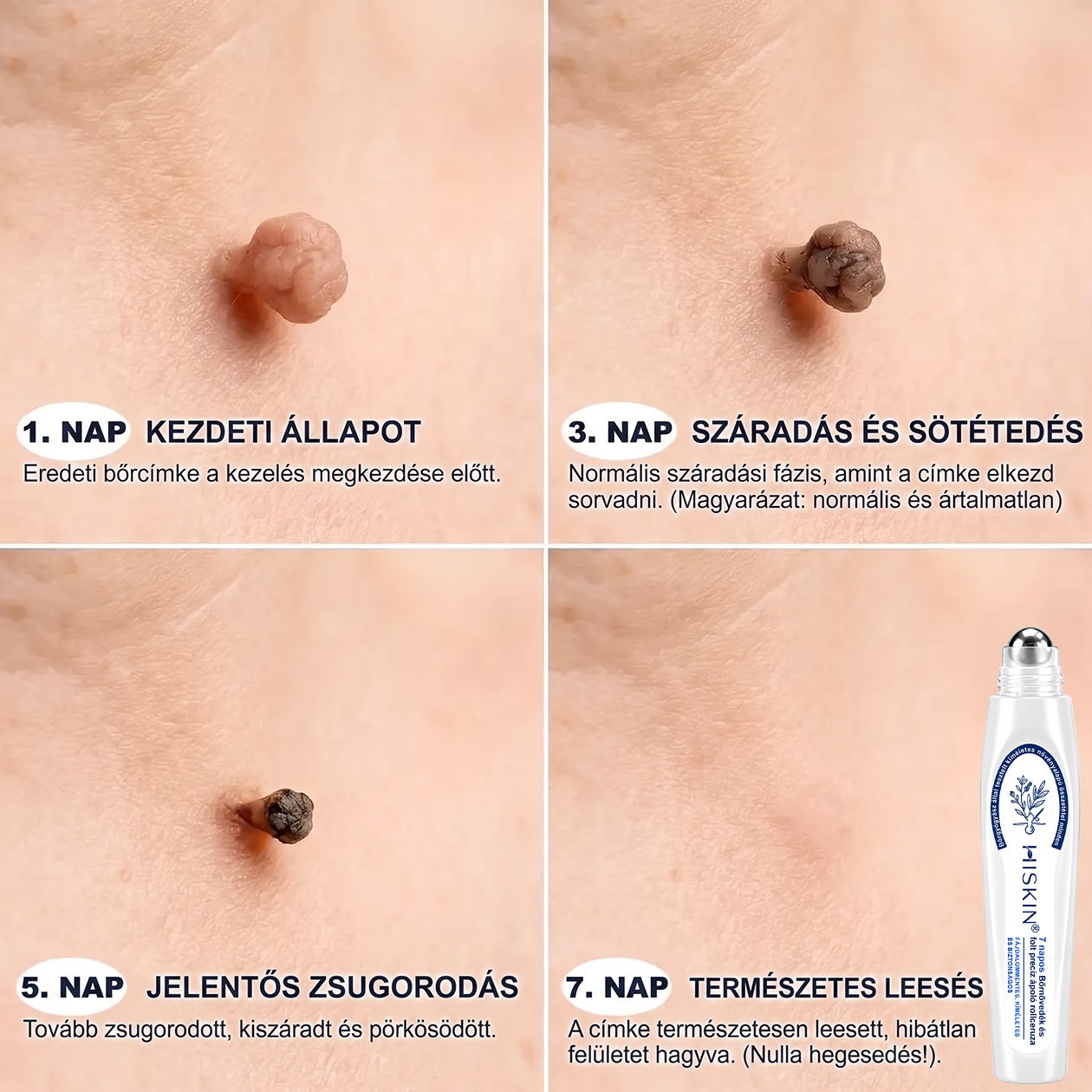 💙Hivatalos Márkabolt | 🚢 Hiskin® 7 napos Szemölcseltávolító Roll-on Ápoló Folyadék (Fájdalommentes rollerball technológia, hegek nélkül) 🐬