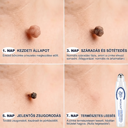 💙Hivatalos Márkabolt | 🚢 Hiskin® 7 napos Szemölcseltávolító Roll-on Ápoló Folyadék (Fájdalommentes rollerball technológia, hegek nélkül) 🐬